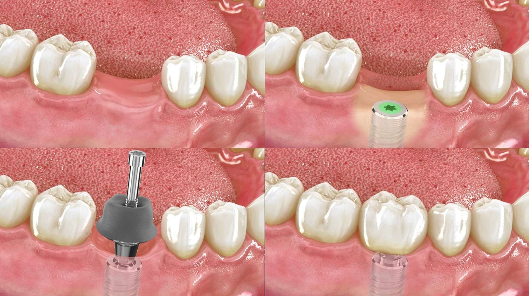 implant dentaire à Nice