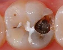 soins-caries