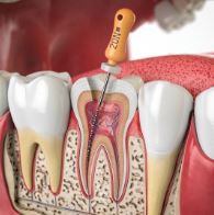 endodontie 